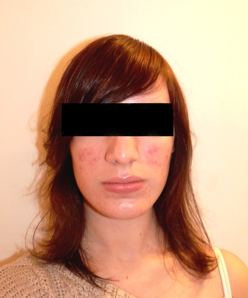 Roaccutane soleil combien de temps - Colchicine Roaccutane soleil combien de temps - Colchicine